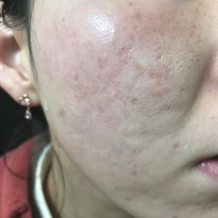 The Ordinary Amino Acid+B5のクチコミ「4/4🌱#汚肌工事録
\いつも閲覧ありがとう😭/
ちょうしがいい、、、!
あと毛穴.....」(1枚目)