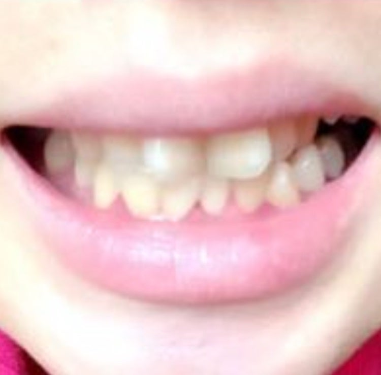 薬用パールホワイトProEX/美健コーポレーション/その他オーラルケアを使ったクチコミ(2枚目)