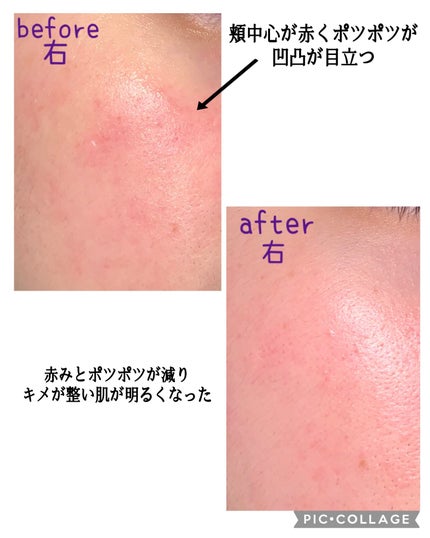 リードルショット300/VT/美容液を使ったクチコミ(7枚目)