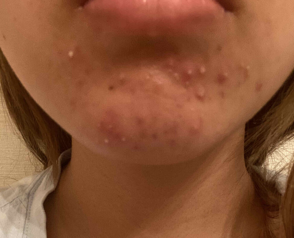 素肌美人VITA/ACROPASS/シートマスク・パックを使ったクチコミ（2枚目）