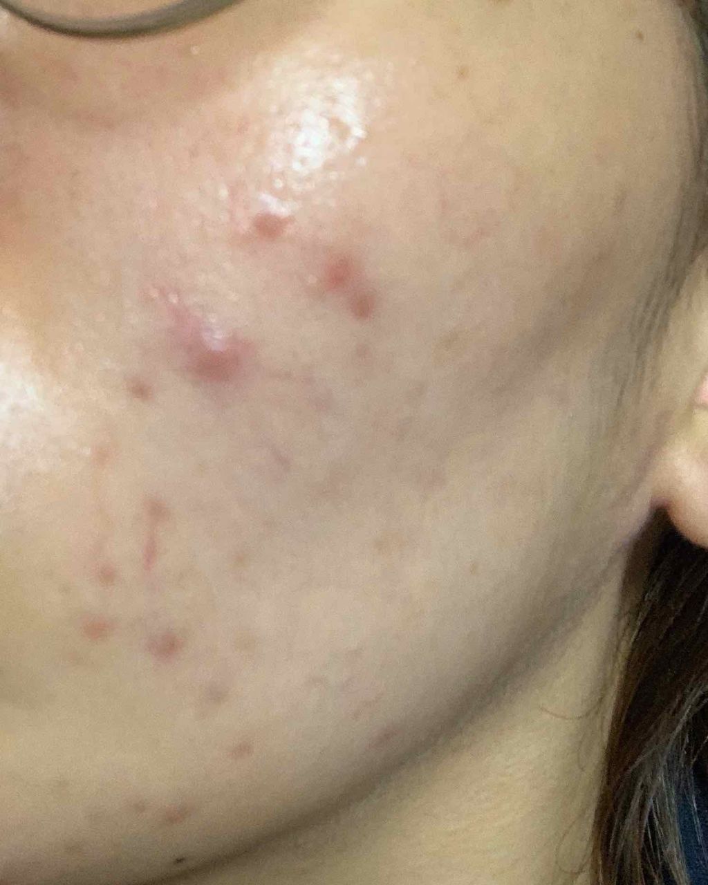 ビューティーケアマスク(ニキビ)/肌美精/シートマスク・パックを使ったクチコミ(2枚目)