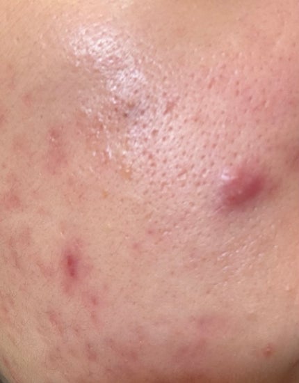 みかん on LIPS 「長年悩み続けたニキビ肌。これから3ヶ月で撲滅します。#はじめて..」(1枚目)