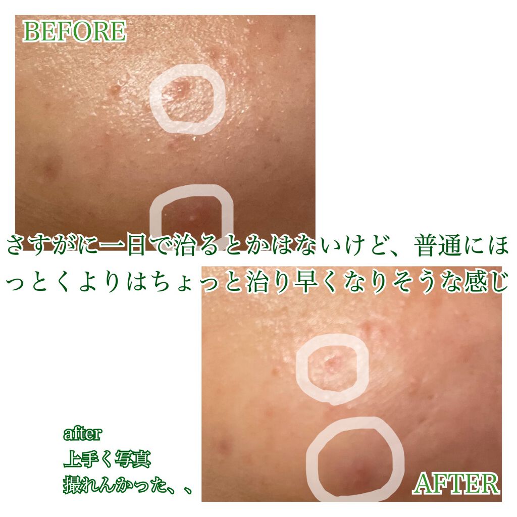 プロCICA クリアスポットパッチ/VT/その他スキンケアを使ったクチコミ(6枚目)