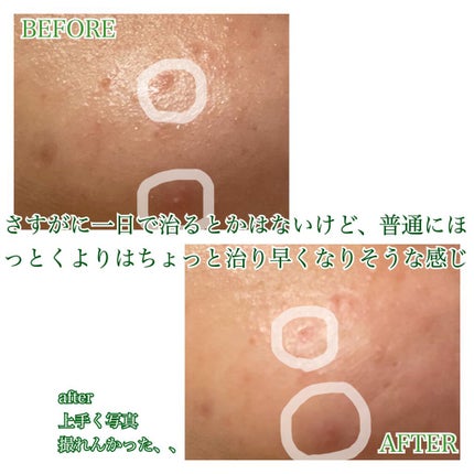 プロCICA クリアスポットパッチ/VT/その他スキンケアを使ったクチコミ(6枚目)