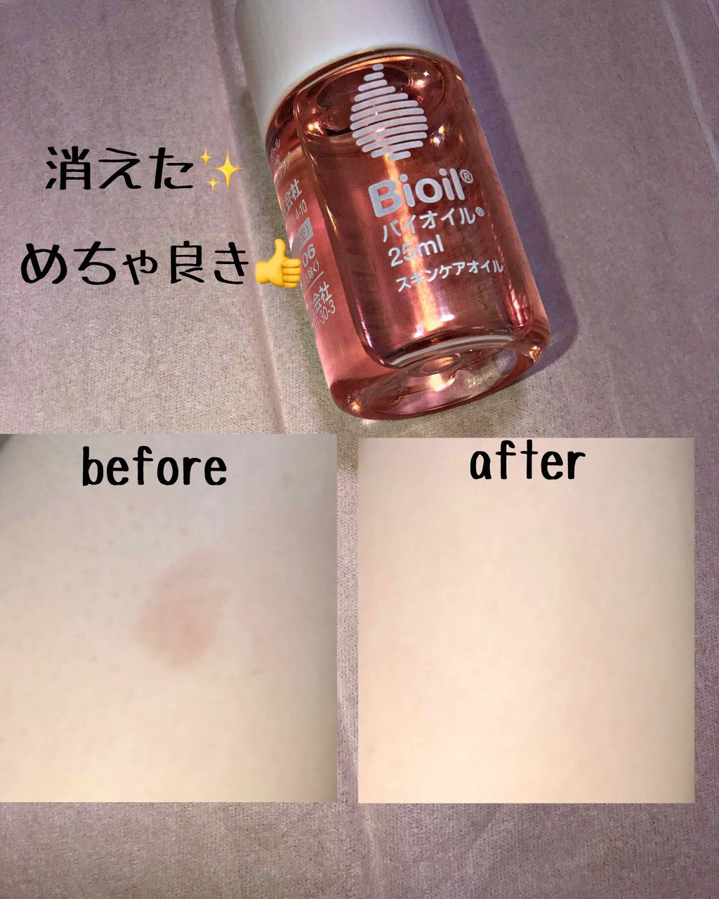 バイオイル/バイオイル/フェイスオイルを使ったクチコミ（1枚目）