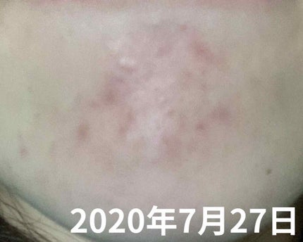 オードムーゲ 薬用ローション(ふきとり化粧水)/オードムーゲ/拭き取り化粧水を使ったクチコミ(3枚目)