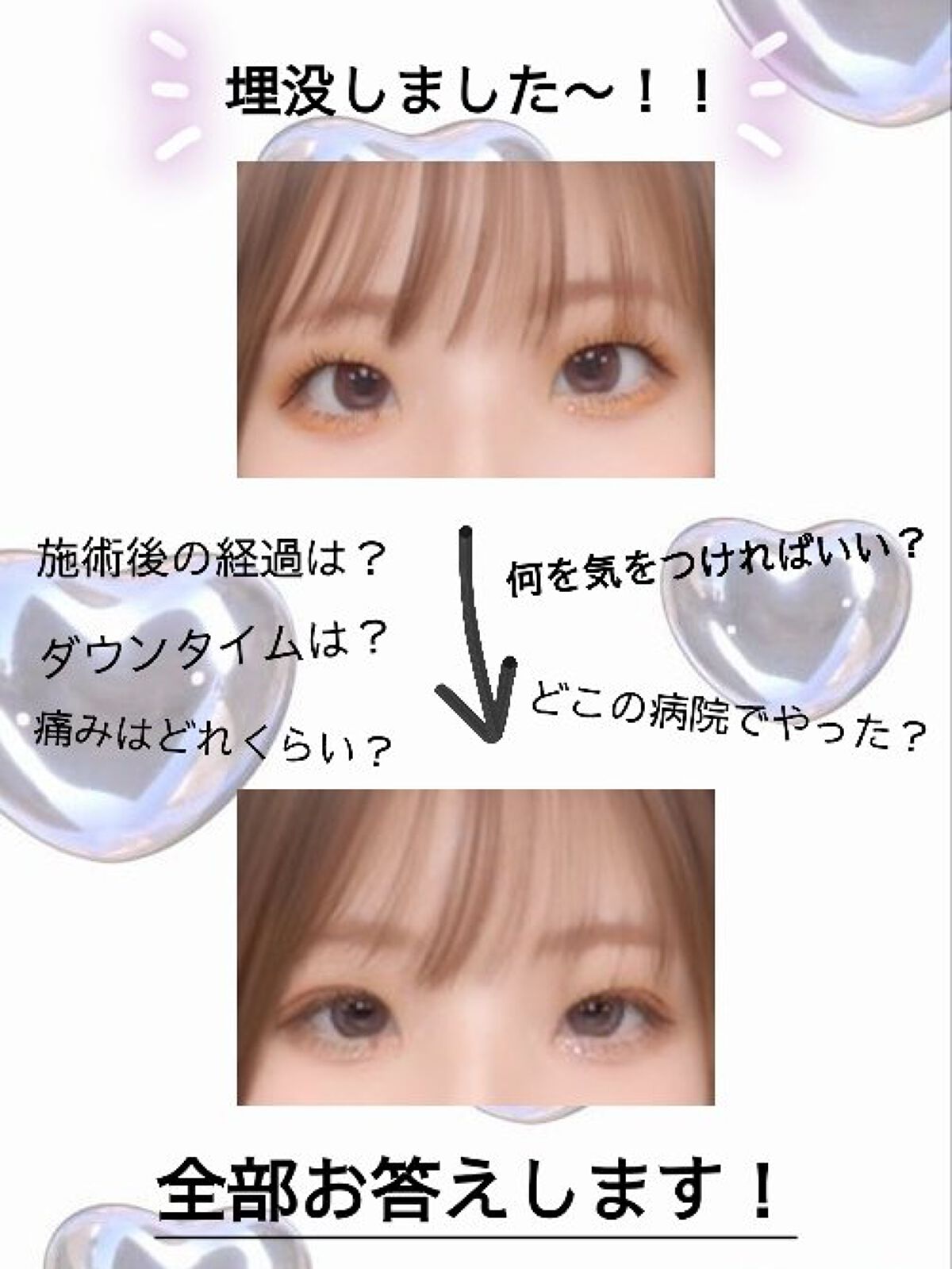 のびーるアイテープ（絆創膏タイプ、レギュラー）/DAISO/二重まぶた用アイテムを使ったクチコミ（1枚目）