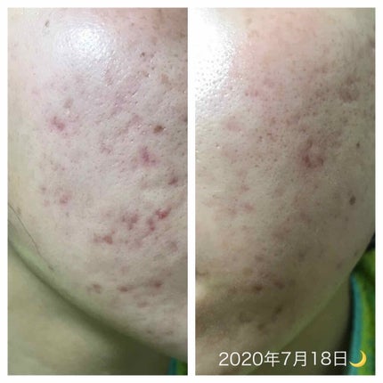 miina@汚肌工事録⚠️ on LIPS 「肌をきれいにするための自分用記録です✏️#汚肌工事録 #暗黒時..」(3枚目)