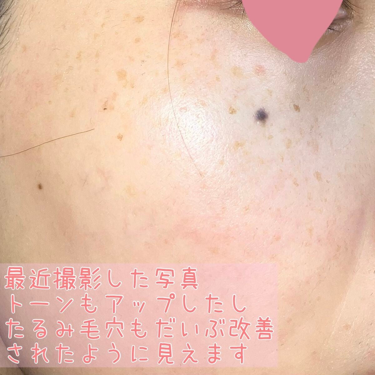 こはる☆フォロバ on LIPS 「・・・肌トラブル過多の私が褒められ肌になるまでの過程!写真は全..」(4枚目)