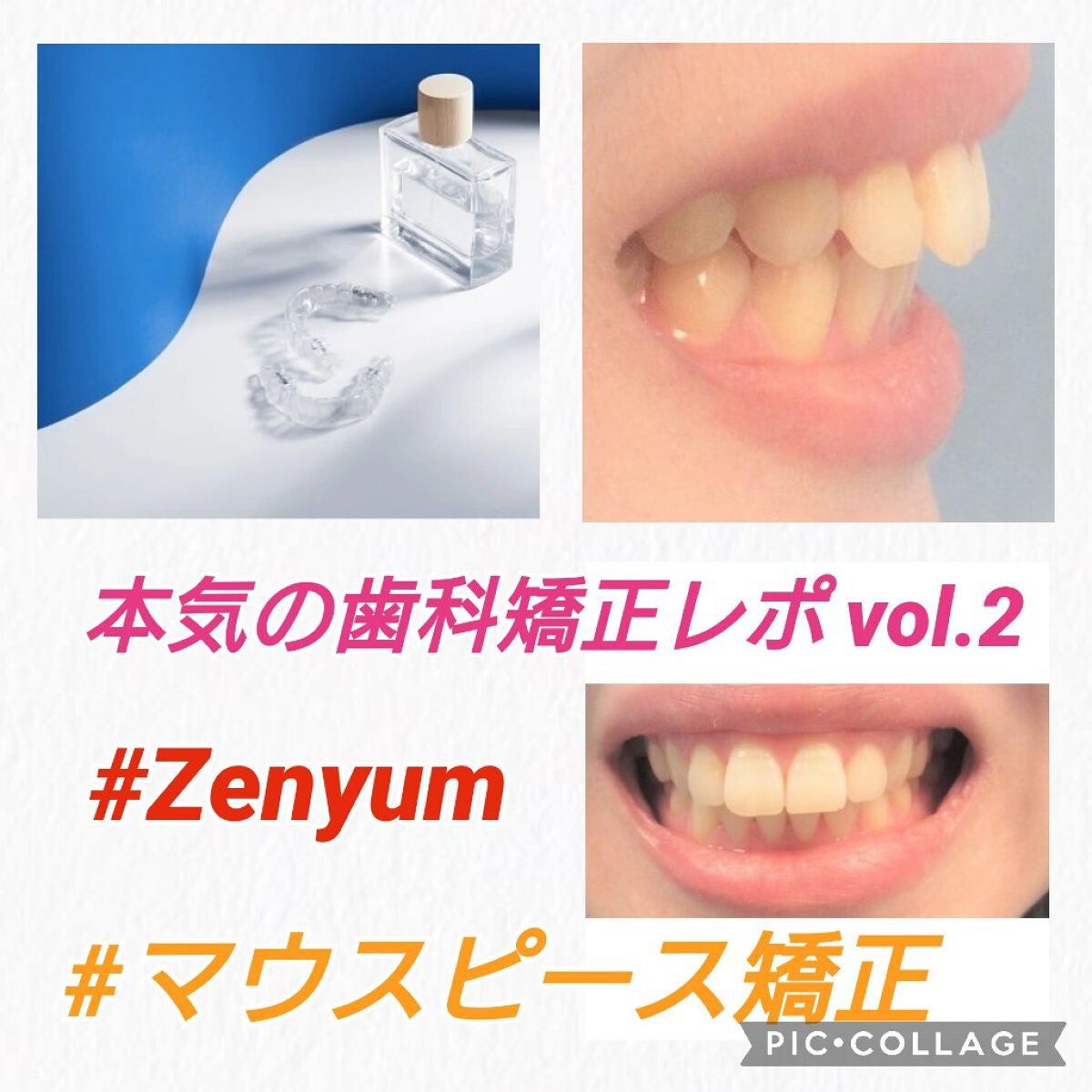 みとらん on LIPS 「さてさて、わたくし、アラフォーにして歯科矯正を始めました。今回..」(1枚目)