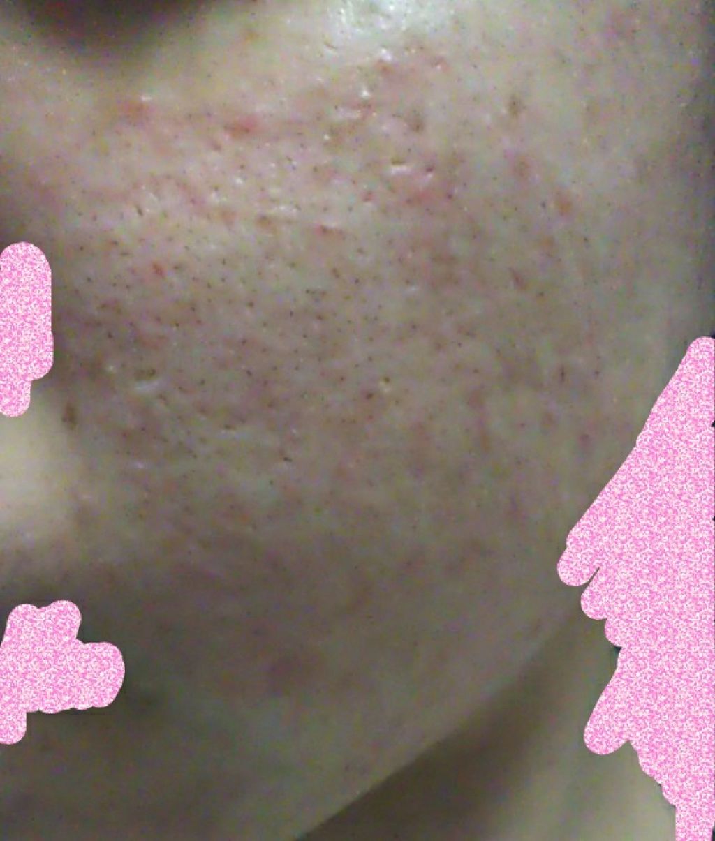 らん on LIPS 「すみません、クチコミではないんですけど…肌日記をつけようと思い..」(2枚目)