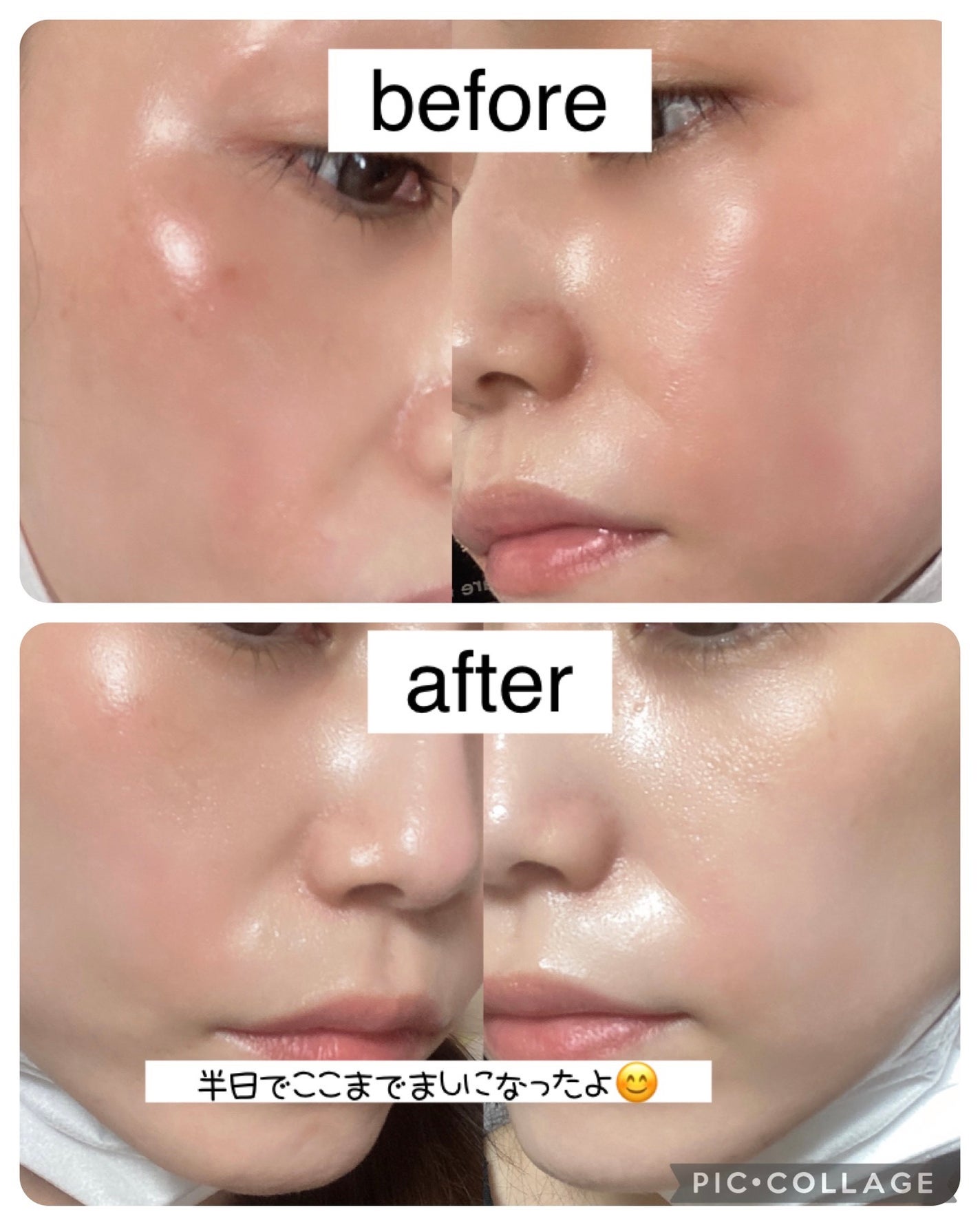 ティーツリーカーミングハイドロジェル/MEDIHEAL/ボディローションを使ったクチコミ(2枚目)