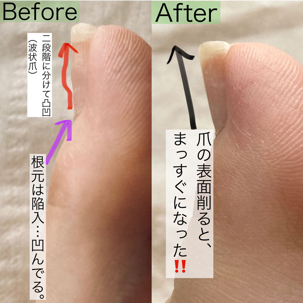 バトルウィン セラポアテープ(キネシオロジーテープ)/ニチバン/その他を使ったクチコミ（3枚目）