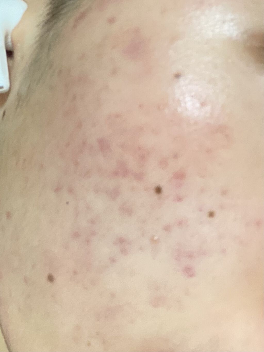 ビーソフテン ローション(医薬品)/持田製薬/その他を使ったクチコミ（1枚目）