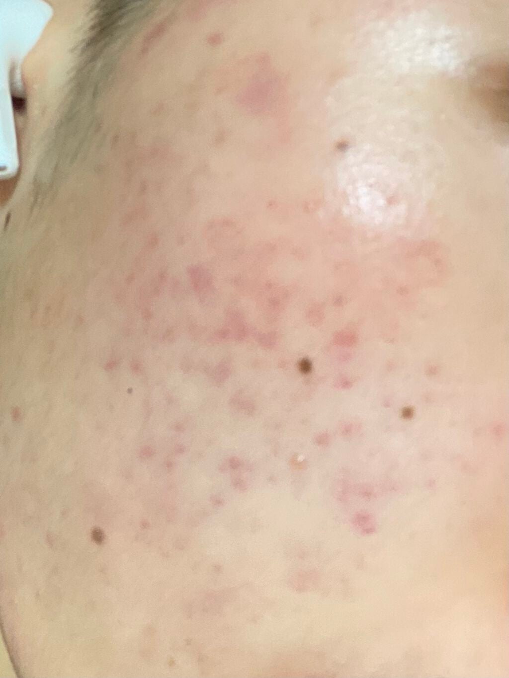 ヒルマイルドクリーム(医薬品)/健栄製薬/その他を使ったクチコミ(1枚目)