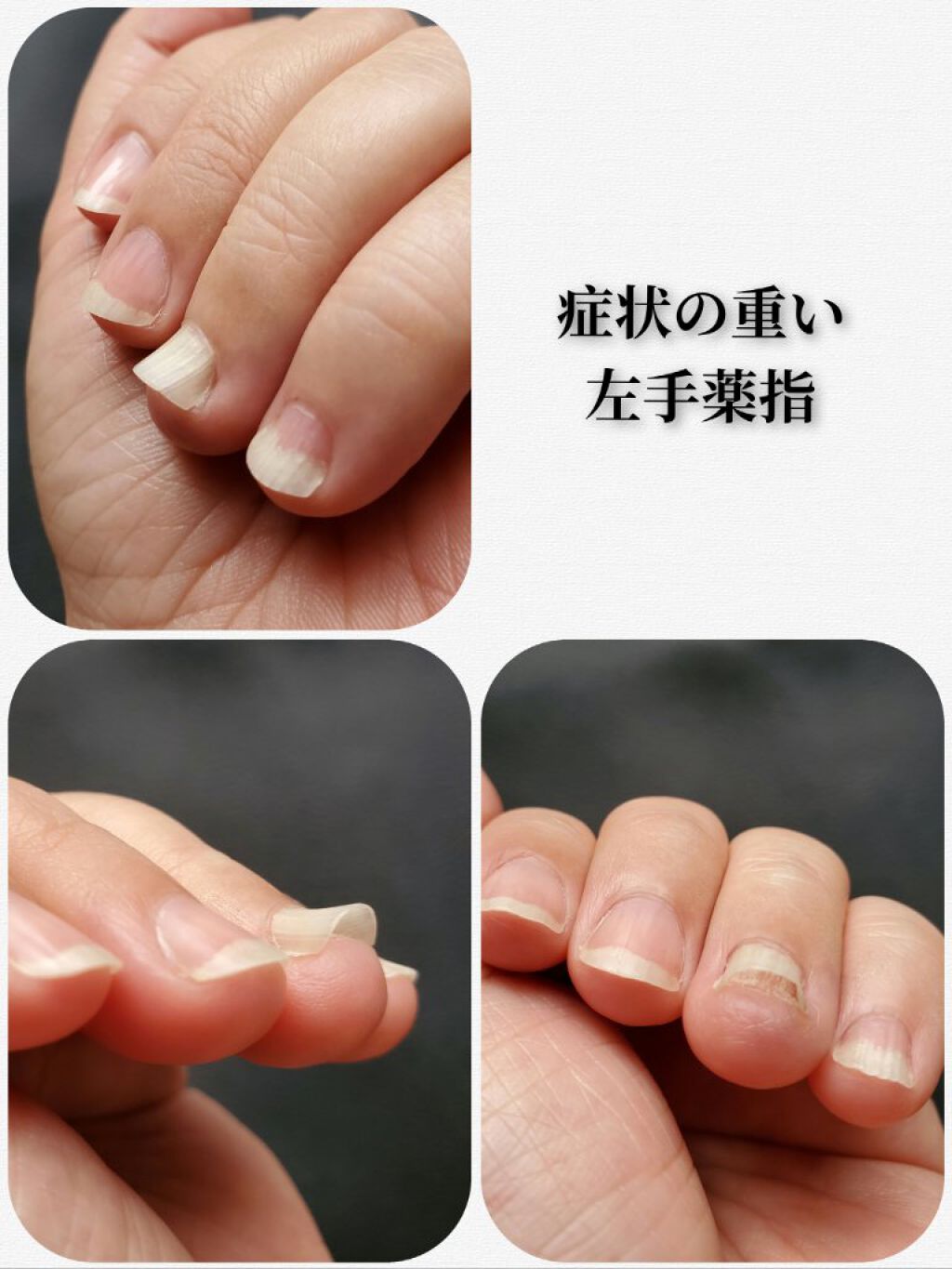 クイックケアコート Ettusaisを使った口コミ お見苦しい画像があります 重度の爪甲剥離 By かぴめろん 気力ダウン 乾燥肌 40代後半 Lips