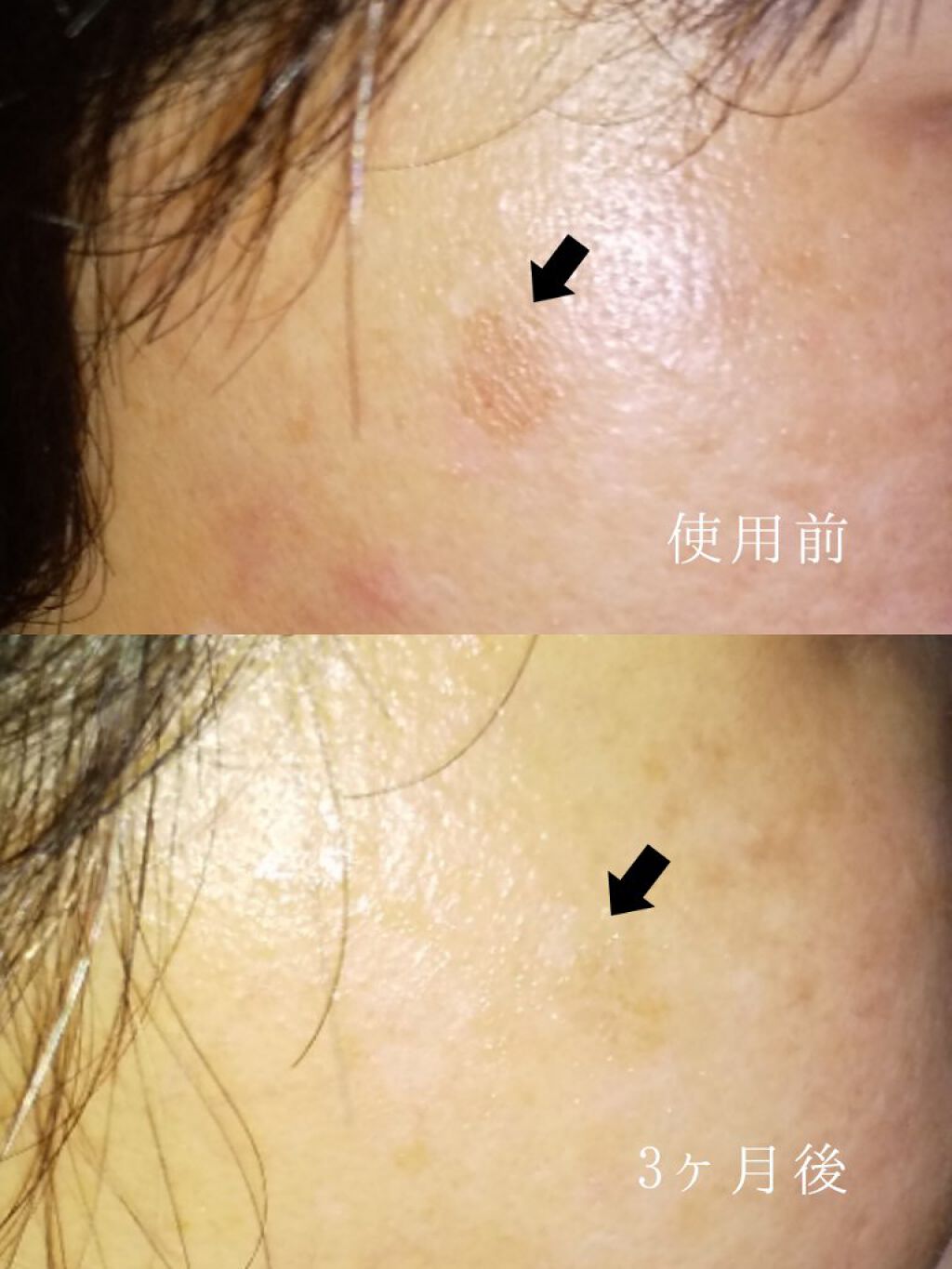 KISO ハイドロクリームPHQ-8のクチコミ「【シミが消えた！ハイドロクリームで美白ケア😲】

🌿KISO ハイドロクリームPHQ-8
  .....」（3枚目）