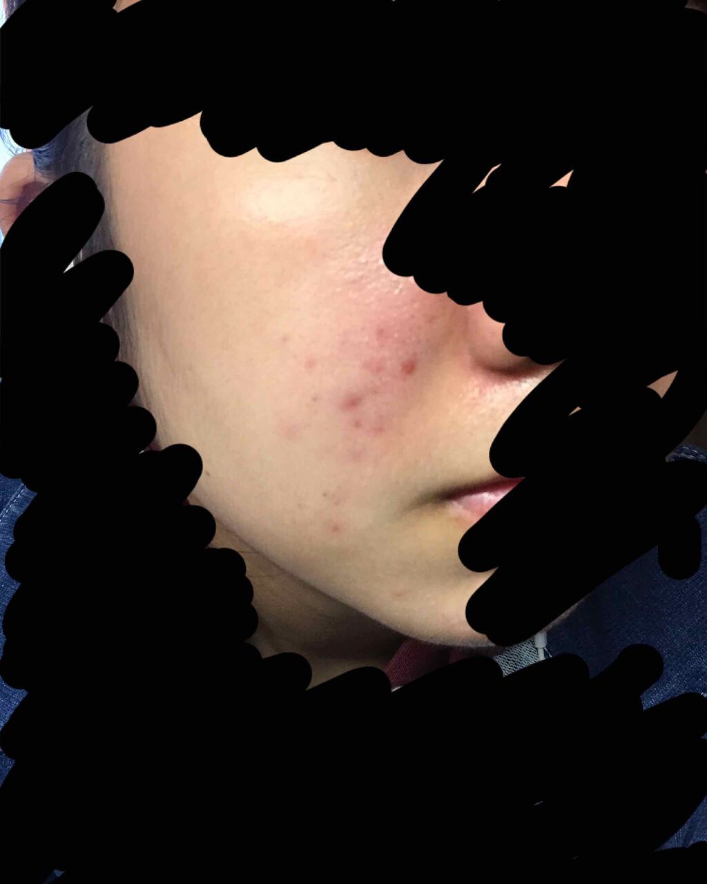 チョコラBBプラス (医薬品)/チョコラBB/その他を使ったクチコミ(2枚目)