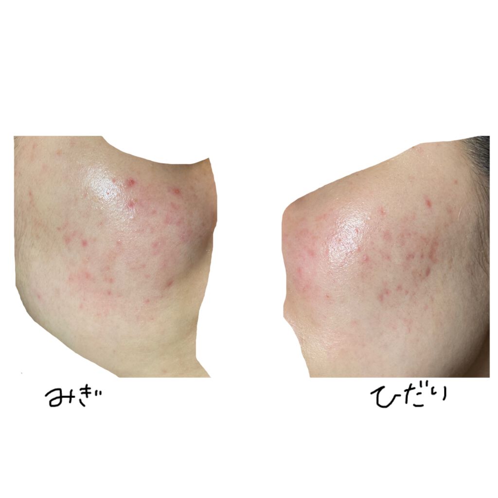 プリスクリードD(医薬品)/IHADA/その他を使ったクチコミ（2枚目）