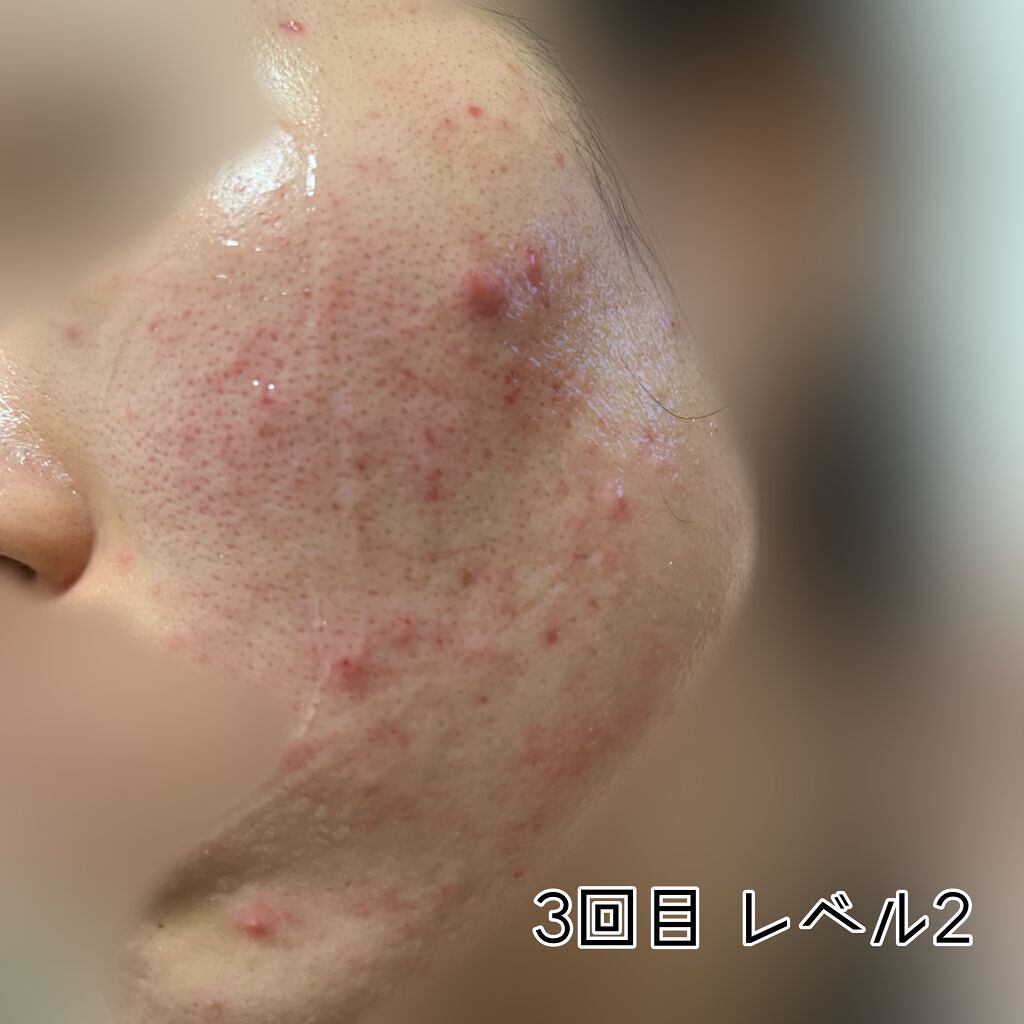 代引き不可 ダーマエアショット sushitai.com.mx