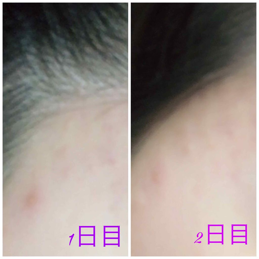 薬用ニキビケア スポッツクリーム/アクネスラボ/フェイスクリームを使ったクチコミ（2枚目）