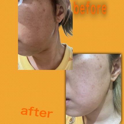 リードルショット100/VT/美容液を使ったクチコミ(1枚目)