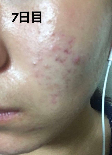 ニキビあとケアジェル/アットノン/その他スキンケアを使ったクチコミ(2枚目)