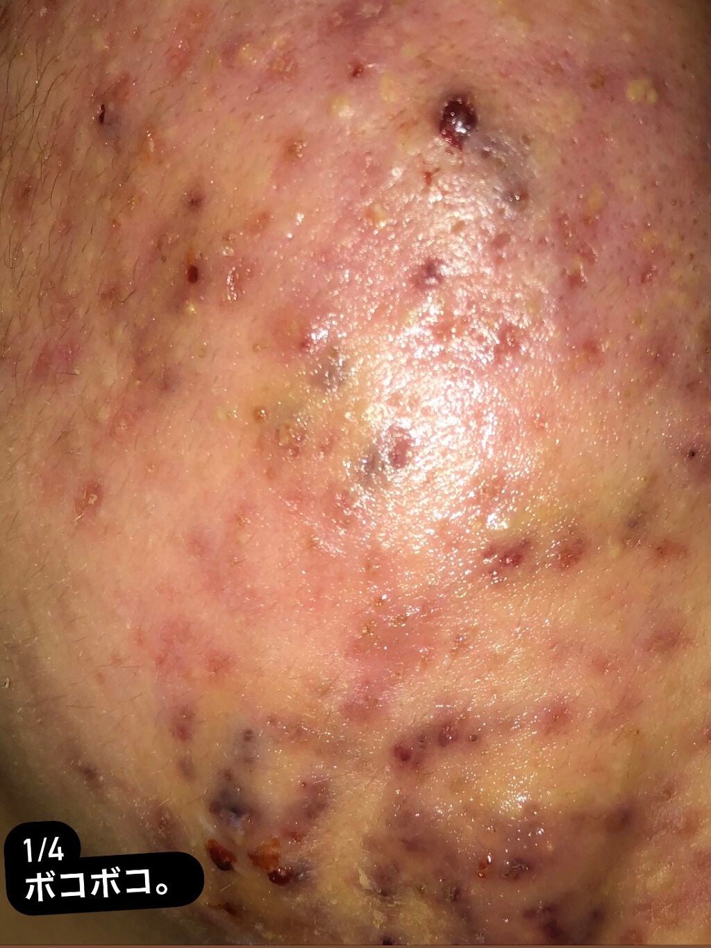 薬用 しみ 集中対策 美容液/メラノCC/美容液を使ったクチコミ(2枚目)