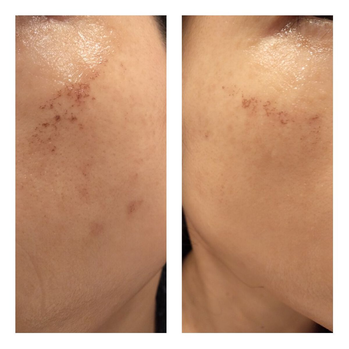 あにゃにゃ♡フォロバ100♡ on LIPS 「11/12に4回目のフォトシルクプラス(シミ取り)を受けてきま..」(2枚目)