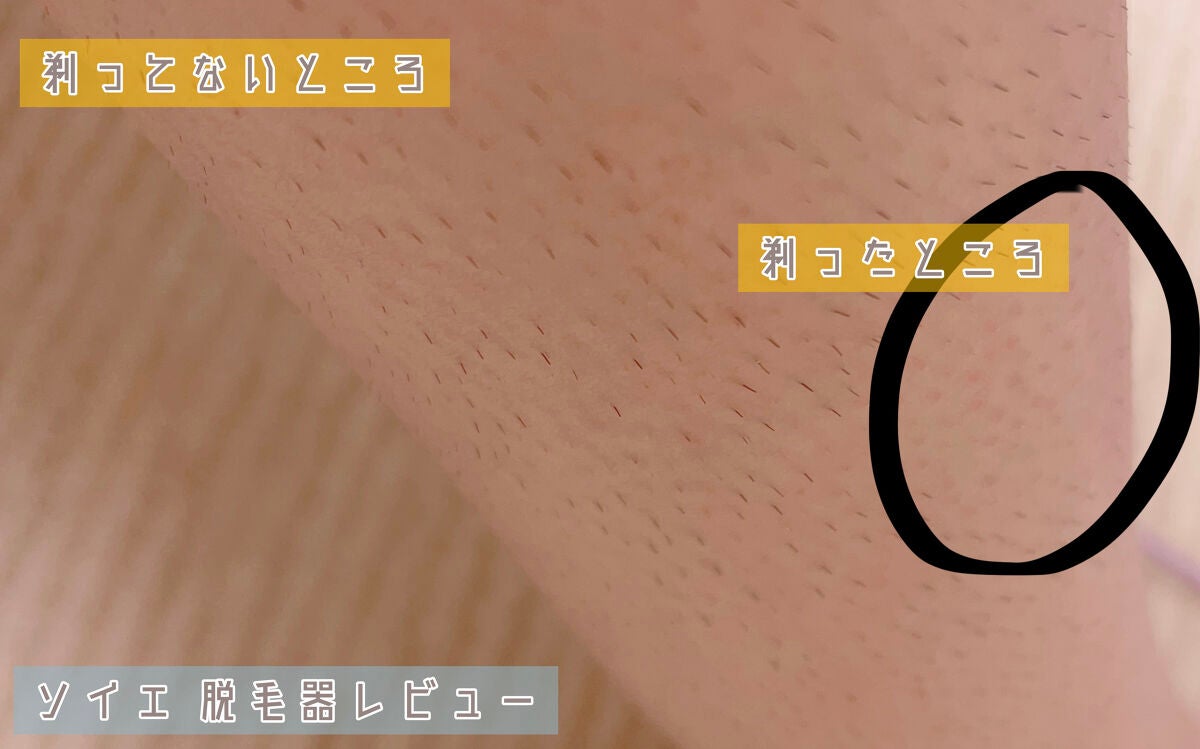 脱毛器 ソイエ ES-WS35 /Panasonic/家庭用脱毛器を使ったクチコミ(3枚目)