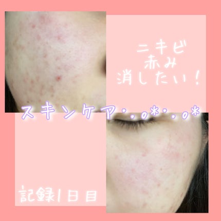 マシュマロホイップ 薬用アクネケア/ビオレ/泡洗顔を使ったクチコミ(1枚目)