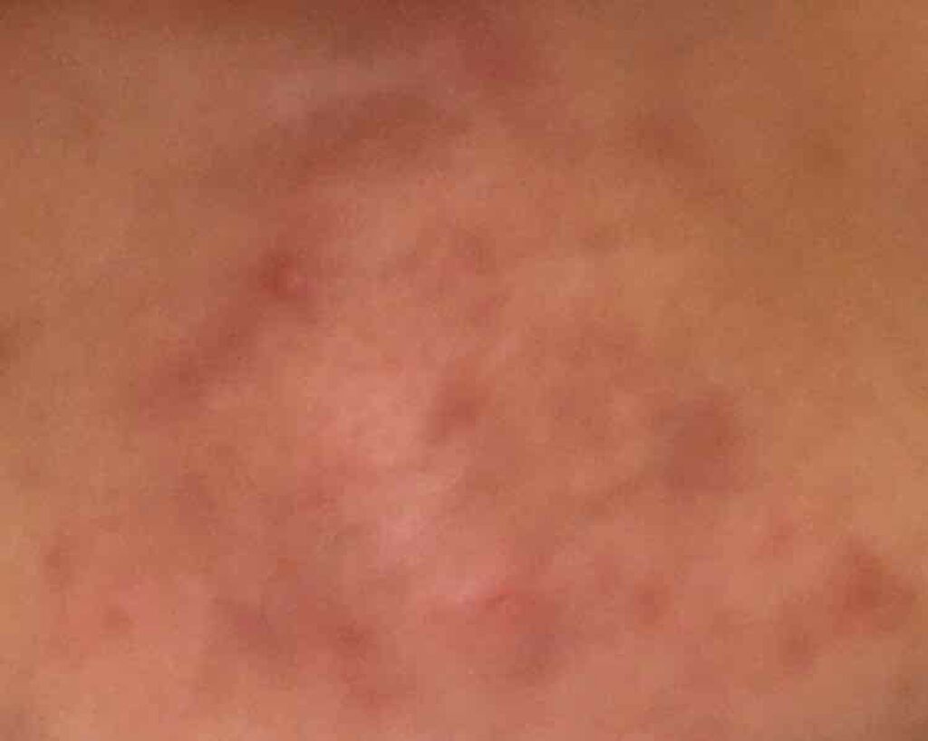 twinkle_lips_c6o on LIPS 「4月2日学校がなくストレスがないおかげか新しいニキビはできませ..」(3枚目)