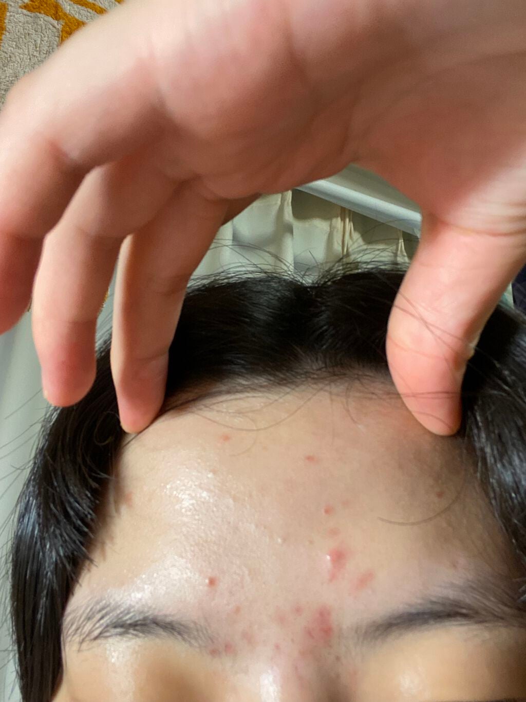 のの on LIPS 「お久しぶりです。一向にニキビが良くならないです。何かいいスキン..」(4枚目)