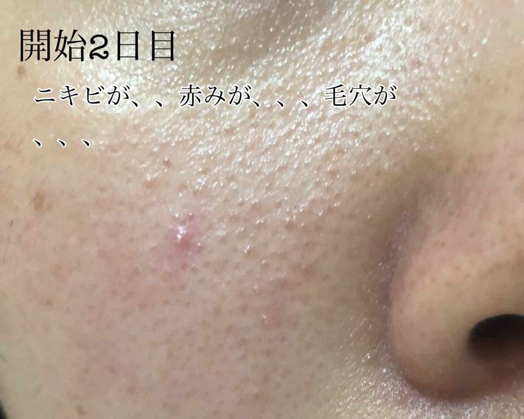 DAISO 酒しずく 化粧水のクチコミ「⚠️2枚目から汚肌注意⚠️
お久しぶりです、ぽちこです！！
最近ライブなりアルバムなりが色々重.....」（2枚目）