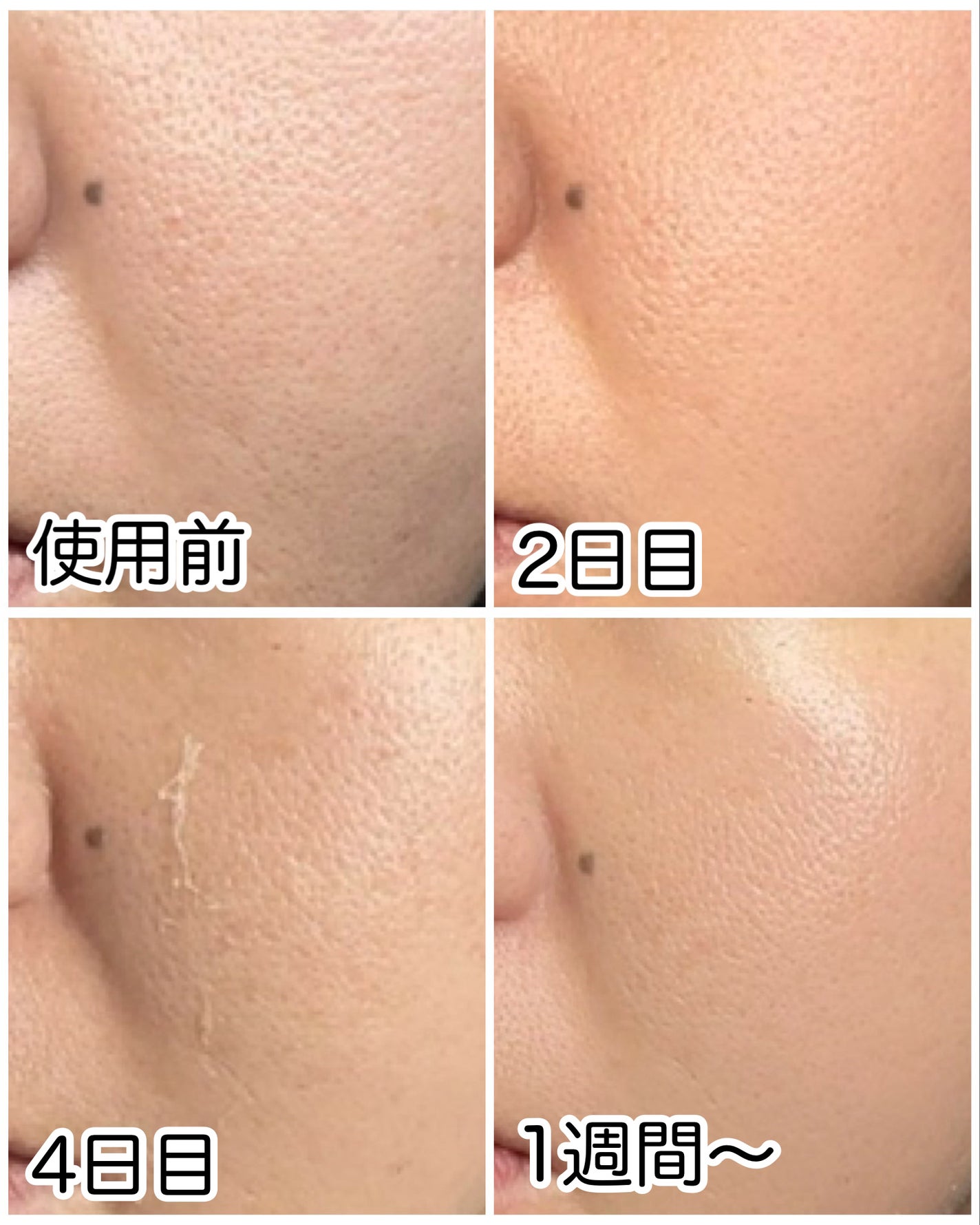 ダーマスキンピーリング/BQCELL/その他キットセットを使ったクチコミ(4枚目)