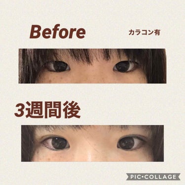 ぬこた on LIPS 「かなり二重も安定してきました。①整形前の画像と比較②カラコンす..」（2枚目）