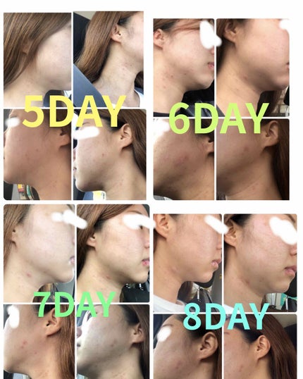 DHC ビタミンCハードカプセル/DHC/美容サプリメントを使ったクチコミ(2枚目)