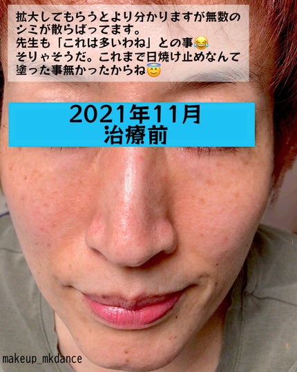トラネキサム酸 250mg/東和薬品/その他を使ったクチコミ(2枚目)
