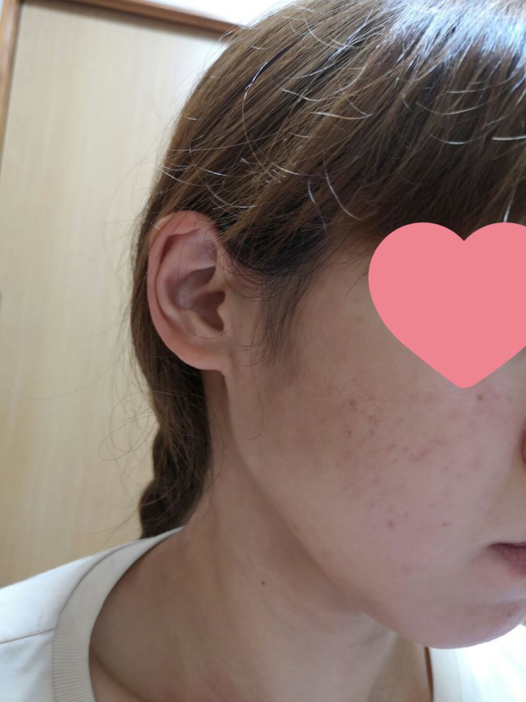 とんぼ on LIPS 「皮膚科に通ってから約5ヶ月経ちました。まえより良くなっている気..」(1枚目)