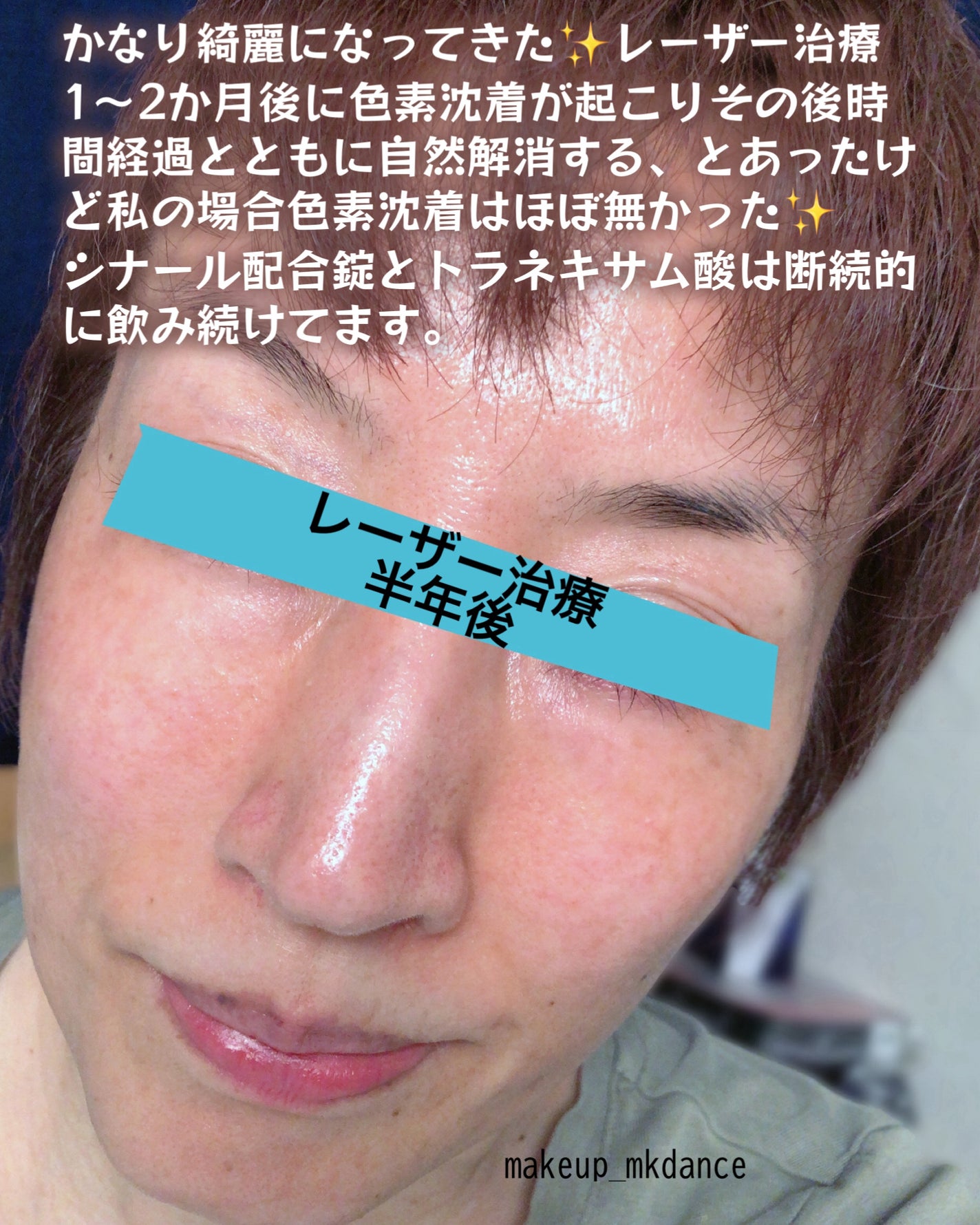 トラネキサム酸 250mg/東和薬品/その他を使ったクチコミ(7枚目)