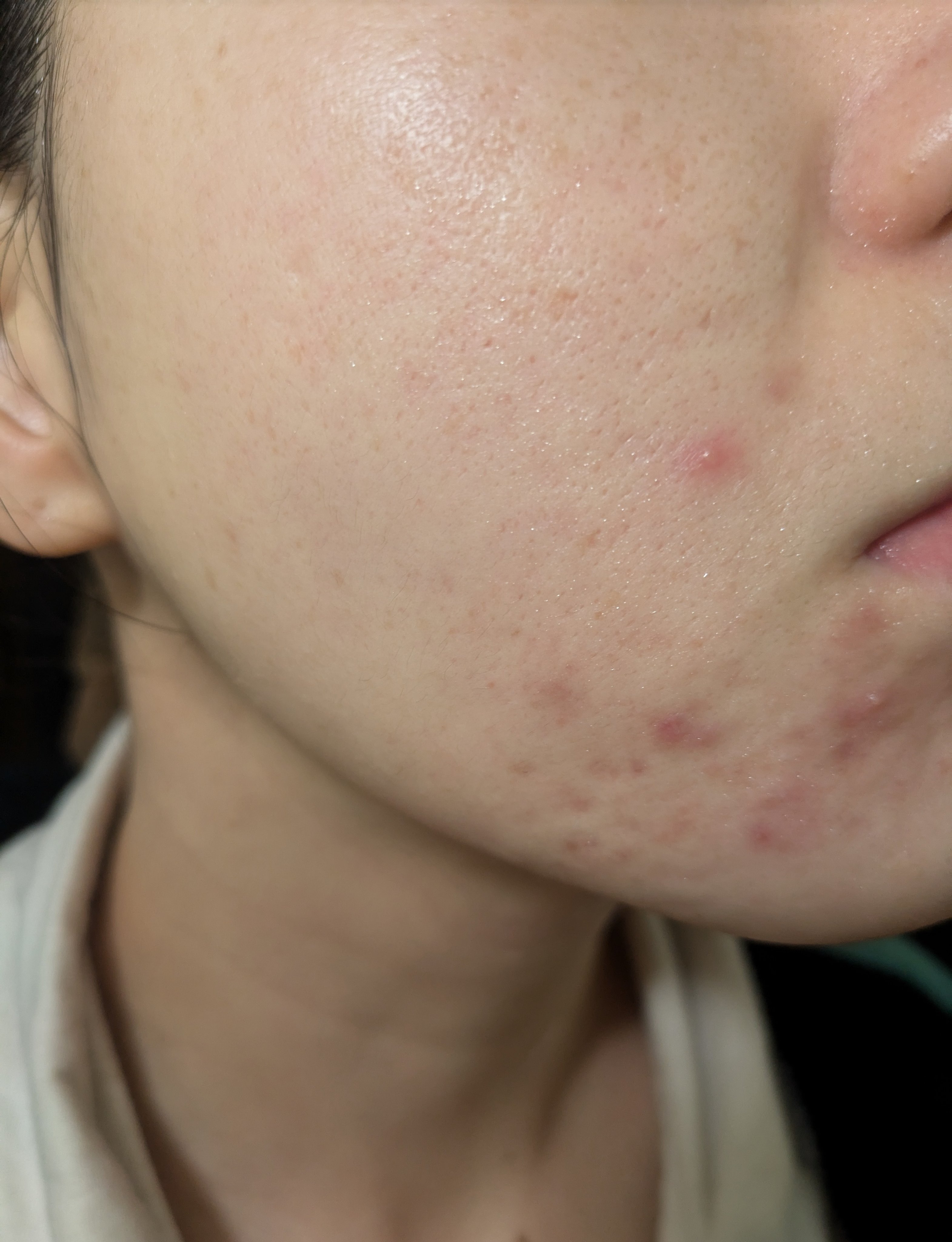 11/14の#汚肌工事録

こう見るとあごまわりの肌がすごくダメージになってるのがわかる…🤔保湿足りない＆ケアしすぎ？？？