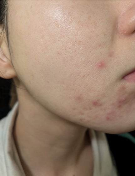 miina@汚肌工事録⚠️ on LIPS 「11/14の#汚肌工事録こう見るとあごまわりの肌がすごくダメー..」(1枚目)