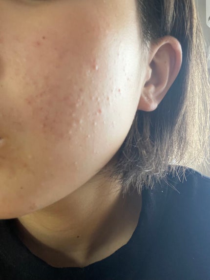 ri on LIPS 「生理周期が安定しているおかげで毎回のように生理が被って肌荒れし..」(2枚目)