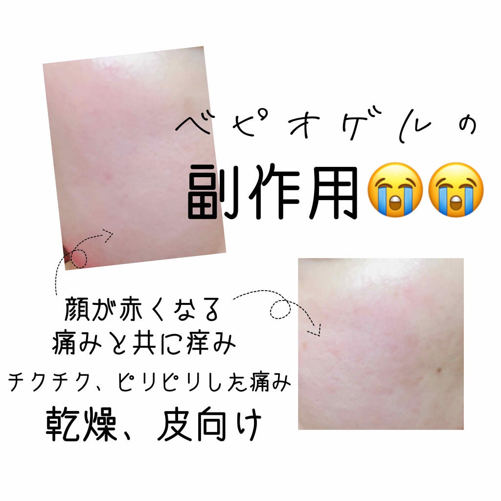 mi on LIPS 「ベピオゲル経過記録🧐マスク荒れで皮膚科に受診した際に相談した毛..」(2枚目)