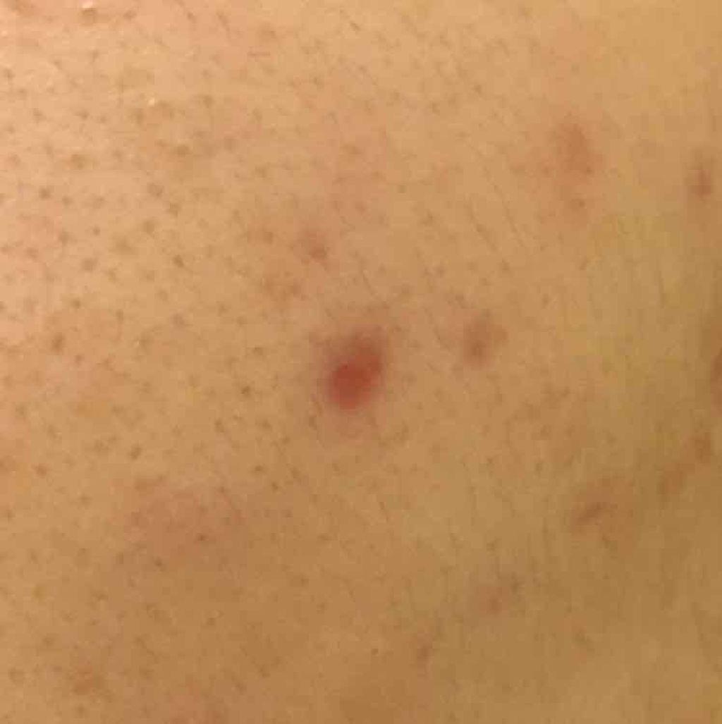 薬用 しみ 集中対策 美容液/メラノCC/美容液を使ったクチコミ(2枚目)