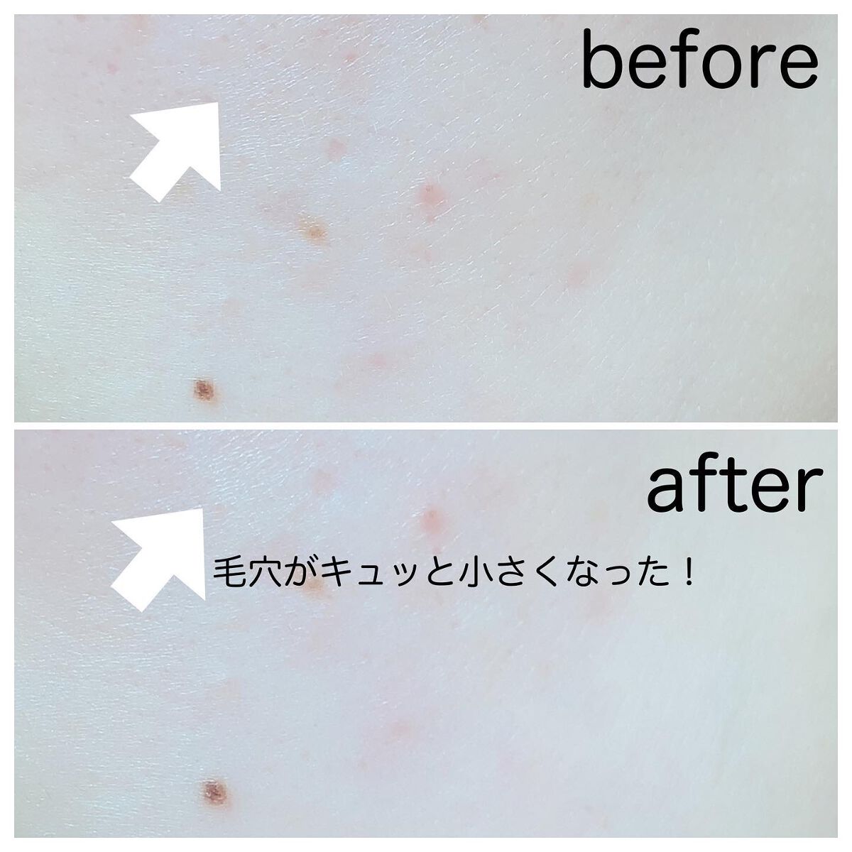 アクネスラボ 相澤メソッド 炭酸パック/HIN アクネスラボ/洗い流すパック・マスクを使ったクチコミ(3枚目)