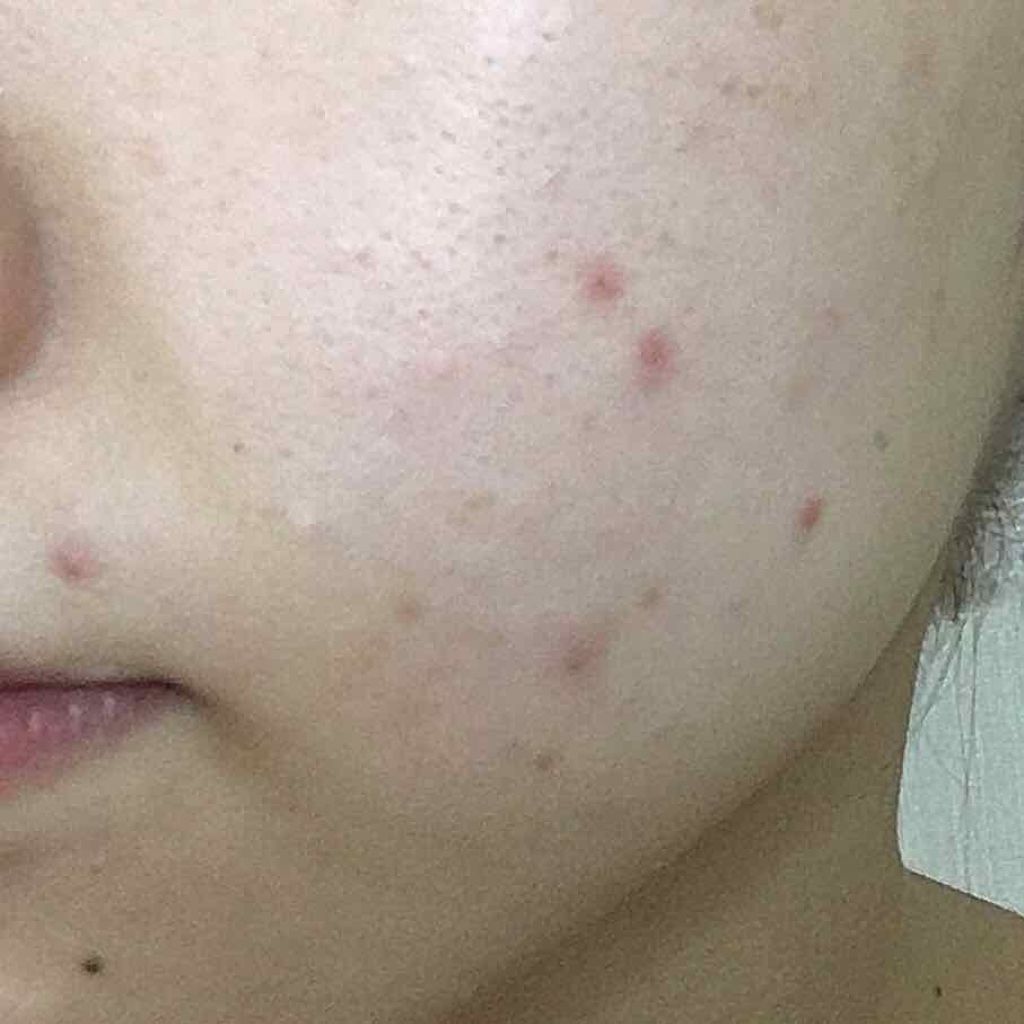 薬用 しみ 集中対策 美容液/メラノCC/美容液を使ったクチコミ（3枚目）