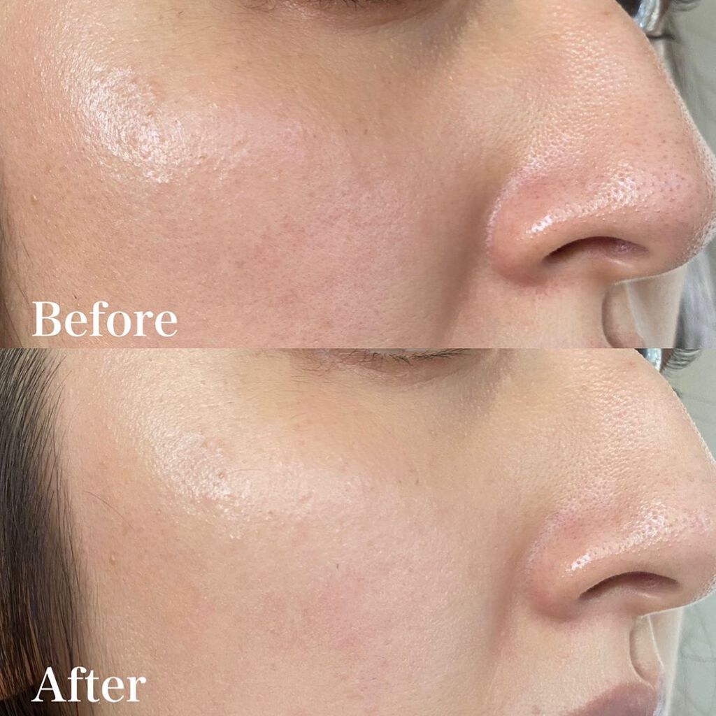 ウルトラ ル タン クッション/CHANEL/クッションファンデーションを使ったクチコミ(6枚目)