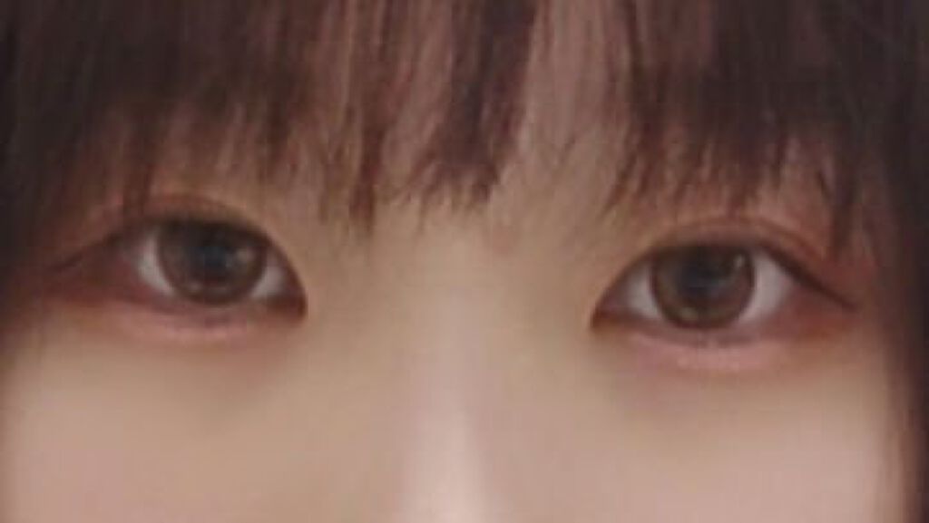 二重整形/その他を使ったクチコミ（3枚目）