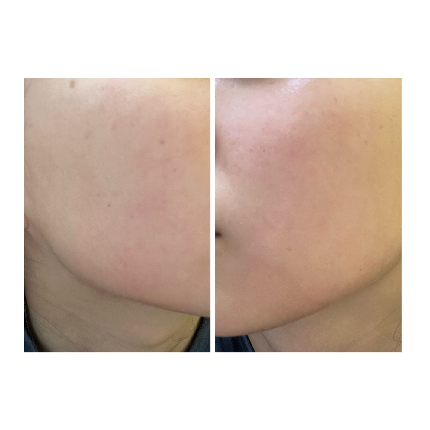 ぽむ on LIPS 「2023.9.13皮膚科に受診 エピデュオとヘパリン処方1枚目..」(2枚目)